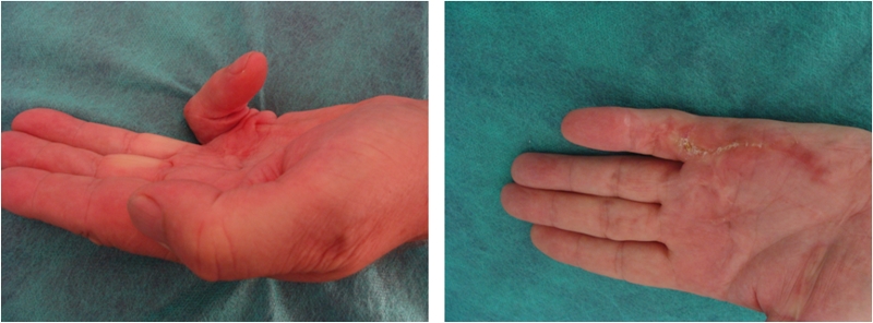 Dupuytren's contracture - after a month
